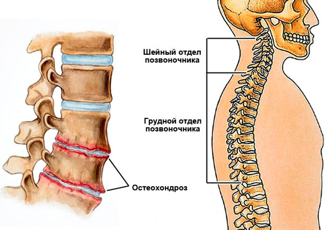 Как отличить остеохондроз от грыжи: 5 ключевых симптомов, которые нельзя игнорировать